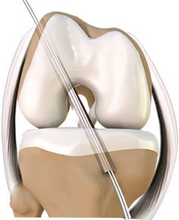 acl reconstruction surgery recovery time​