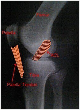 ACL Reconstruction surgery