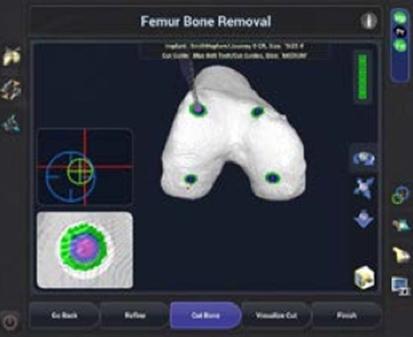 femur bone removal img