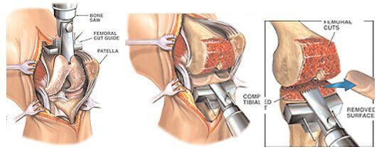 knee replacement surgery image
