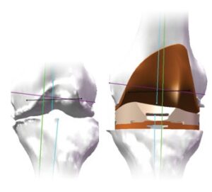 knee replacement virtual alignment img