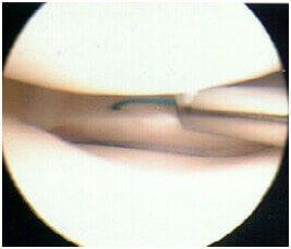 Meniscal Repair