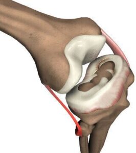 Meniscal Replacement
