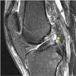 recovery time for acl reconstruction surgery​