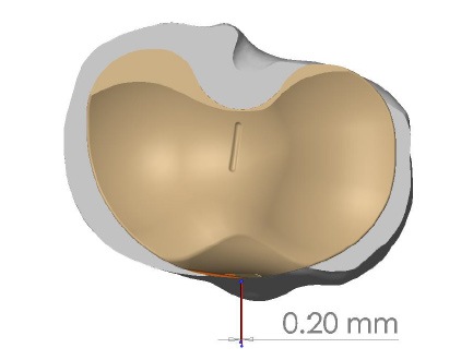 nizam alignment marking tibia