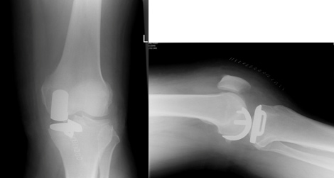 partial knee replacements img