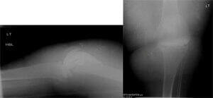 revision knee replacement img1