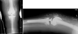 revision knee replacement img2