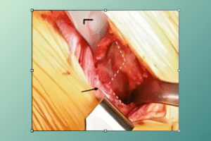 anterior hip replacement surgery​