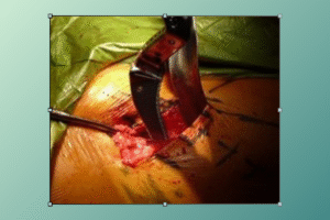 hip replacement protocol​