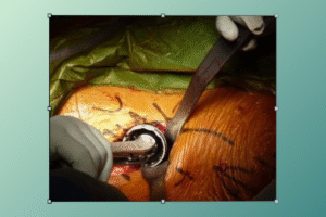 recovery from hip surgery time​