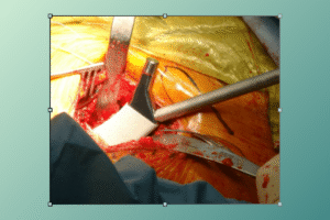 what to expect the first week after hip replacement surgery​
