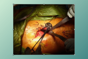 hip replacement scar anterior​