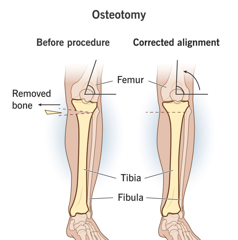 22688 osteotomy e1754386814804