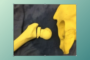 hip replacement surgery recovery time​