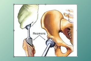 hip replacement cost​