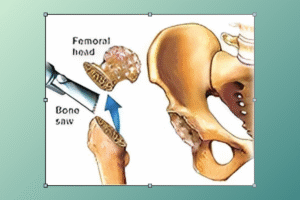 total hip operation​