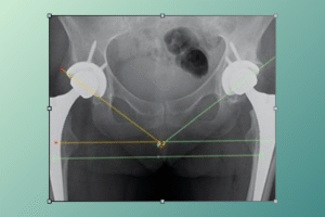 anterior method of hip replacement​