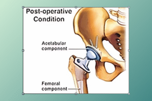 hip replacement surgery cost​