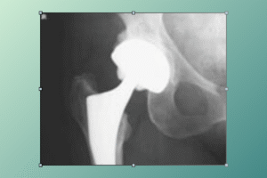 replacement of hip​