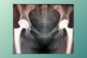 total hip replacement​