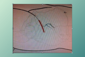 anterior hip replacement pain after surgery​