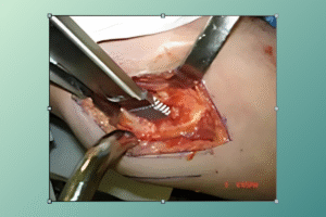 hip replacement recovery time 75 year-old​