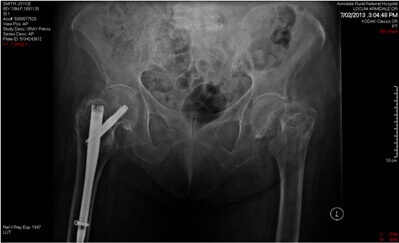 fractures