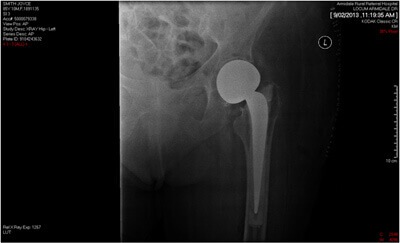growth plate fractures